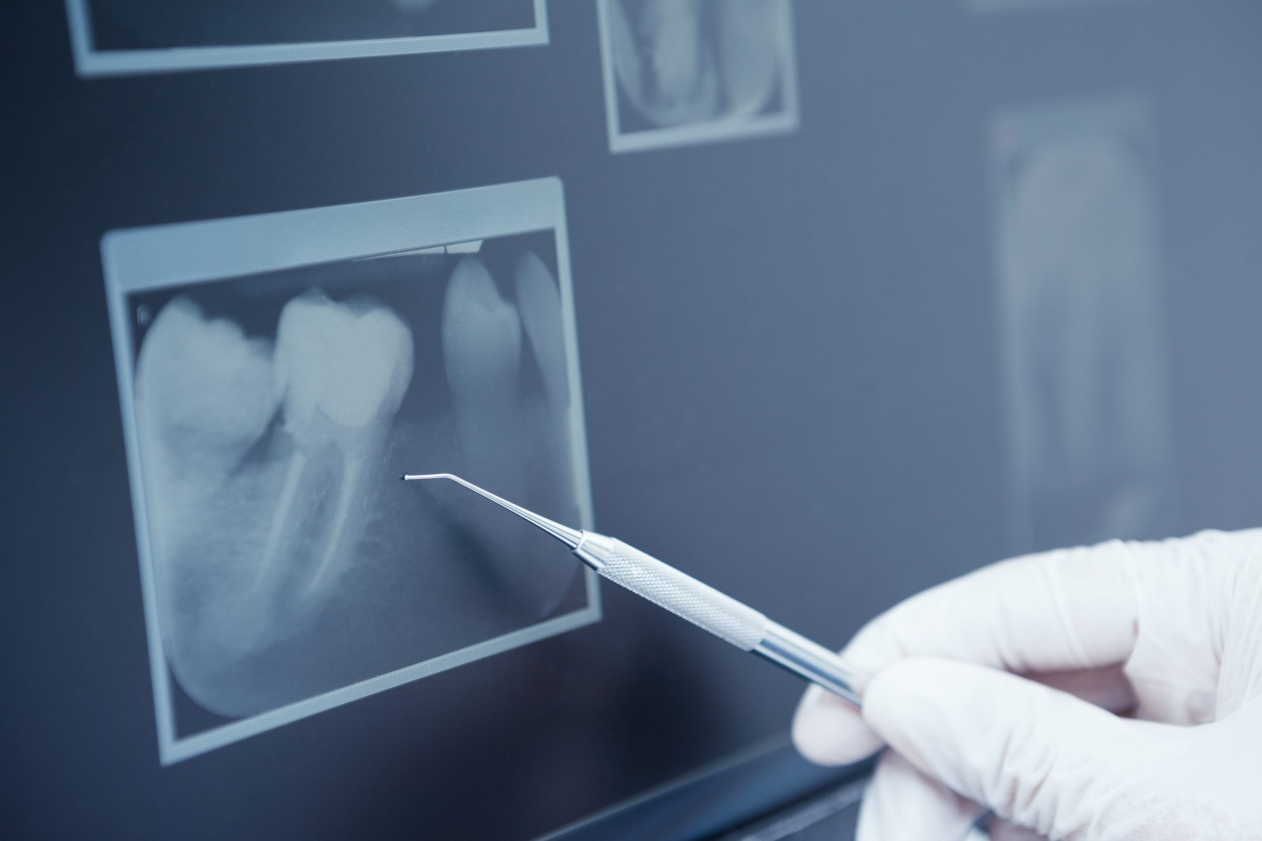 Tooth xray at scholes family dental