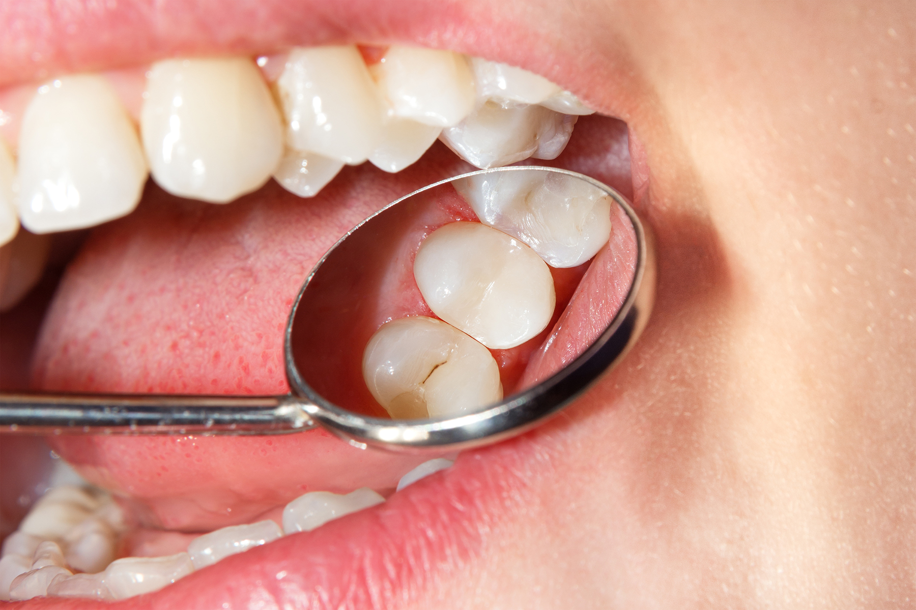 Dental sealant treatment in Coeur d'Alene, ID